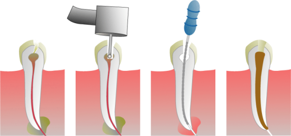 Endodoncia especializada